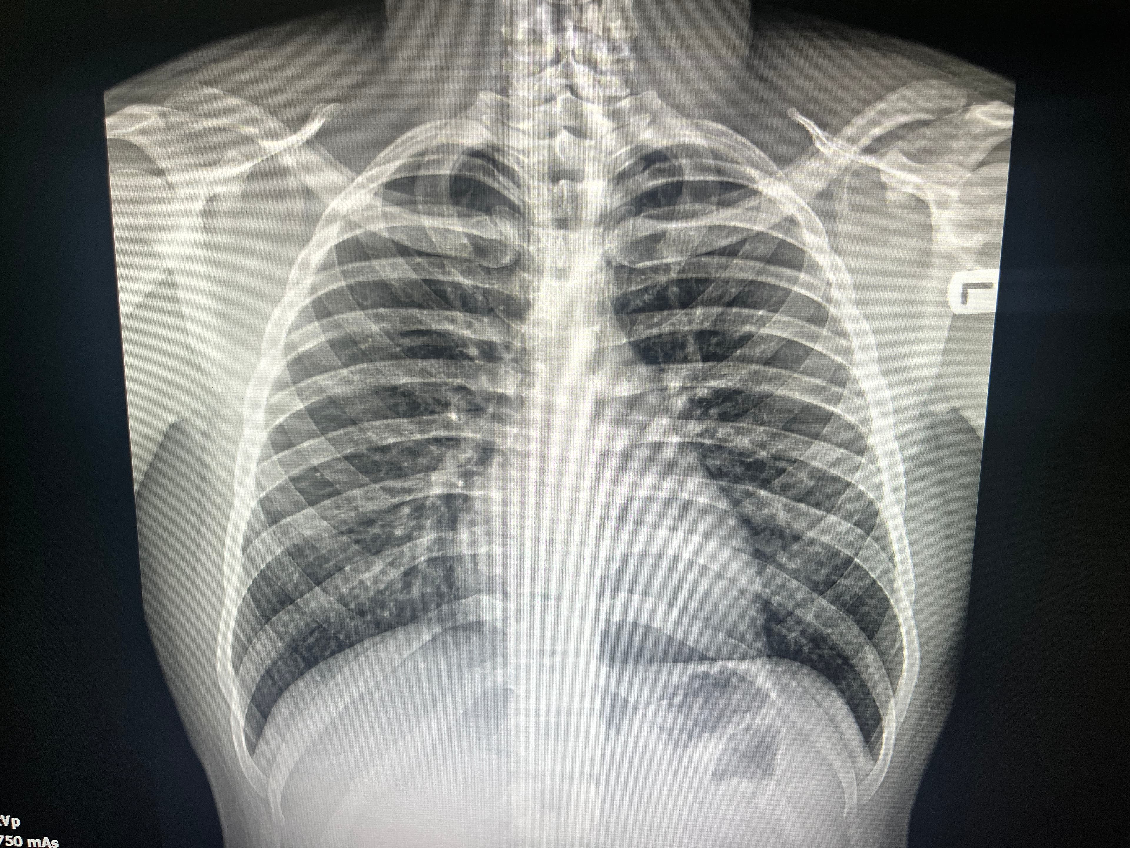 Radiografia de tórax ilustrando localização anatômica em IA médica