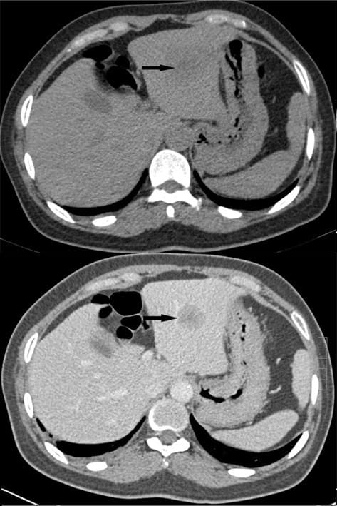 Tomografias computadorizadas comparativas do fígado, sem e com contraste, com foco em tumor hepático
